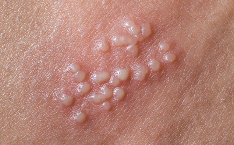 bệnh lây qua đường tình dục